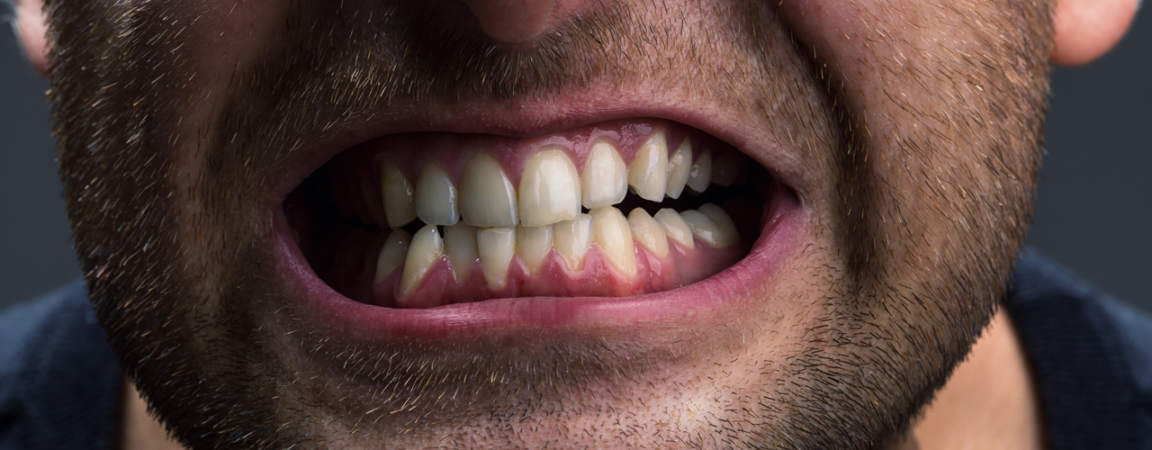 Studio Dentistico Oriolo | Bruxismo Digrignamento Dentale
