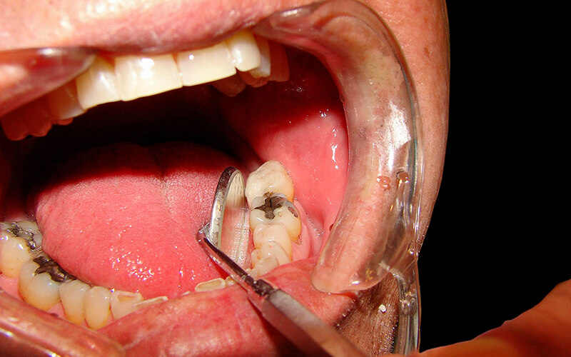 Studio Dentistico Oriolo | Dentista a Lido di Ostia | Terapia Dentale Conservativa - Otturazioni