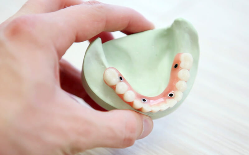 Studio Dentistico Oriolo | Dentista a Lido di Ostia | Protesi Dentale Fissa