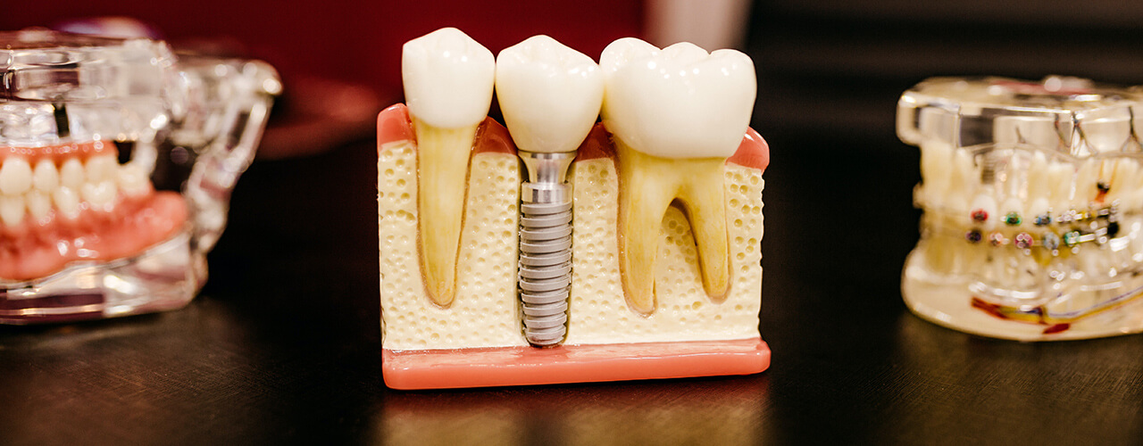 Studio Dentistico Oriolo | Dentista a Lido di Ostia | Implantologia Dentale