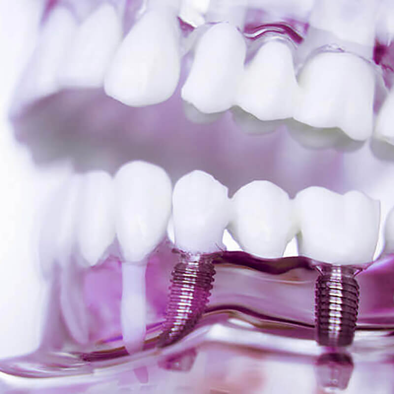 Studio Dentistico Oriolo | Dentista a Lido di Ostia | Implantologia Dentale