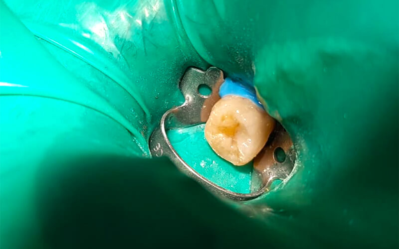 Studio Dentistico Oriolo | Dott.ssa Carmen oriolo Odontoiatra Lido di Ostia | Otturazioni Dentali