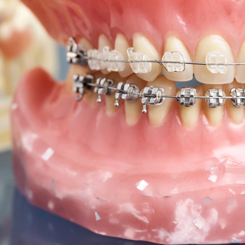 Studio Dentistico Oriolo | Lido Di Ostia | Ortodonzia Terapia Ortodontica Fissa