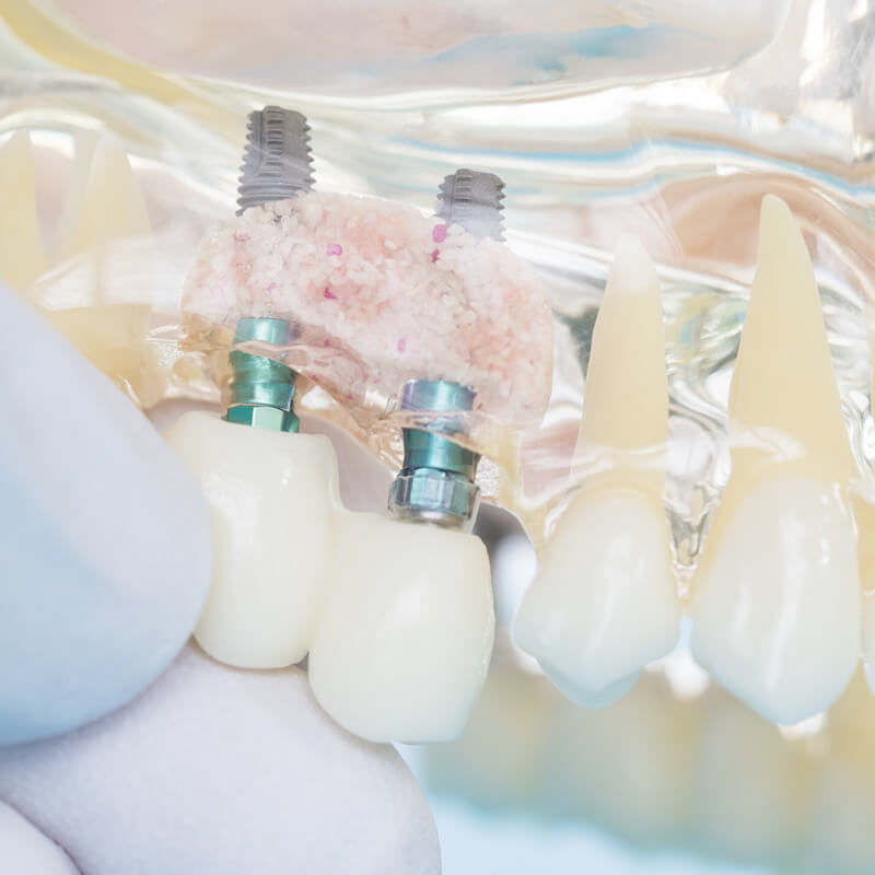 Studio Dentistico Oriolo | Impianti Dentali Rigenerazione Ossea