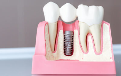 Impianti Dentali: Tutte le Domande e le Risposte