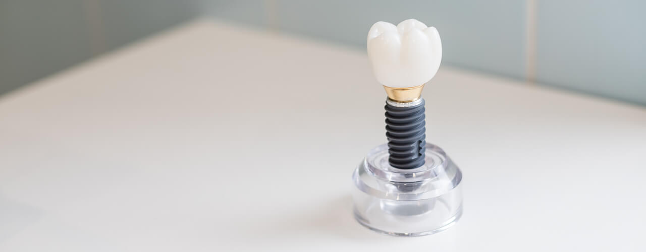 Studio Dentistico Oriolo | Impianti Dentali