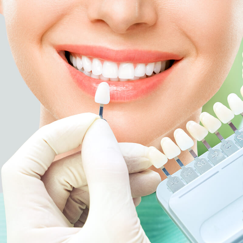Studio Dentistico Oriolo | Sbiancamento Dentale Colore Denti