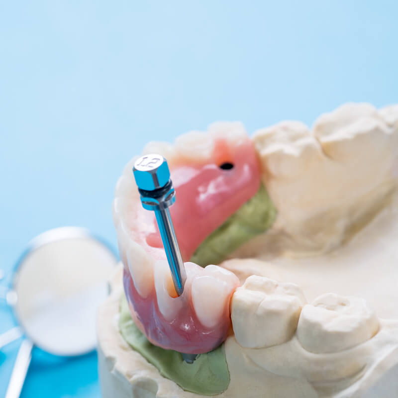 Studio Dentistico Oriolo | Salute Orale Durante La Terza Protesi Fissa Su Impianti