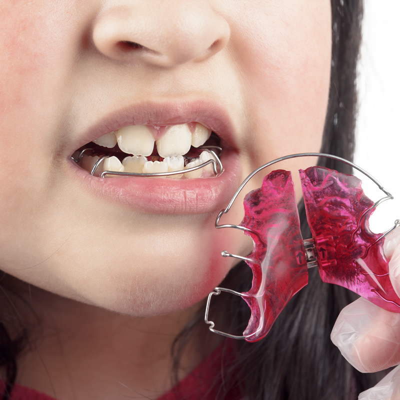 Studio Dentistico Oriolo | Lido Di Ostia | Ortodonzia Terapia Ortodontica Mobile Bambini
