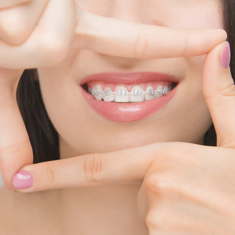 Studio Dentistico Oriolo | Lido Di Ostia | Terapia Ortodontica Ortodonzia Fissa Adulti