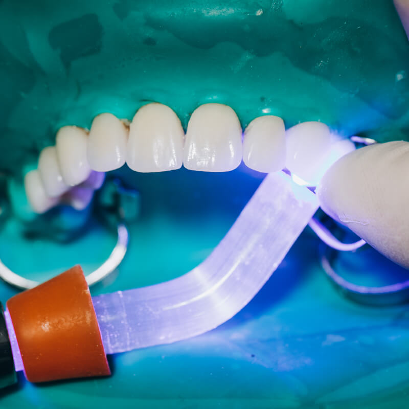 Studio Dentistico Oriolo | Faccette Dentali Estetiche