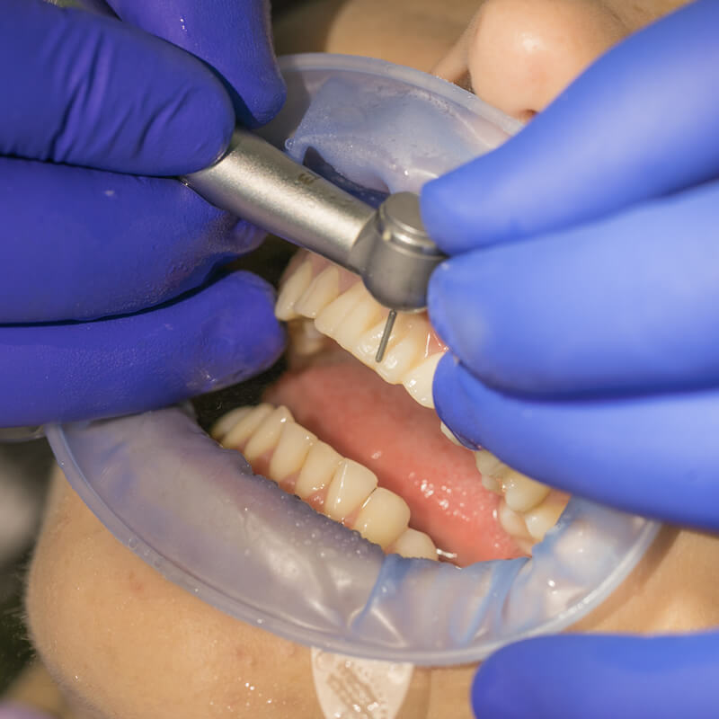 Studio Dentistico Oriolo | Faccette Dentali Estetiche