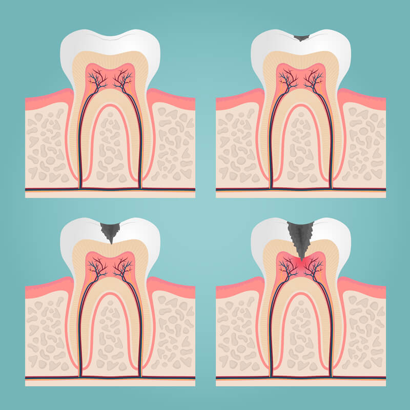 Studio Dentistico Oriolo | Ostia Lido | Carie Dentale