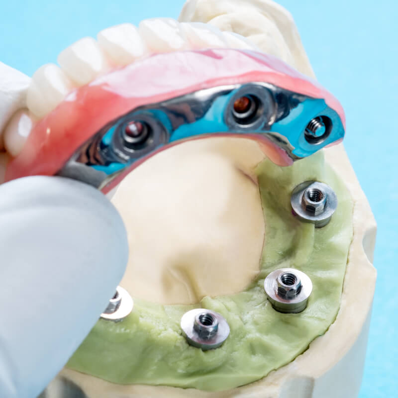 Studio Dentistico Oriolo | Ostia Lido | Protesi Fissa Su Impianti Toronto Bridge