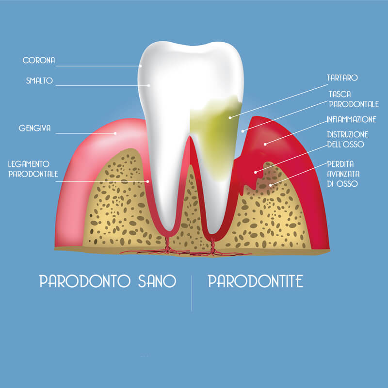 Studio Dentistico Oriolo | Ostia Lido | Parodontite 