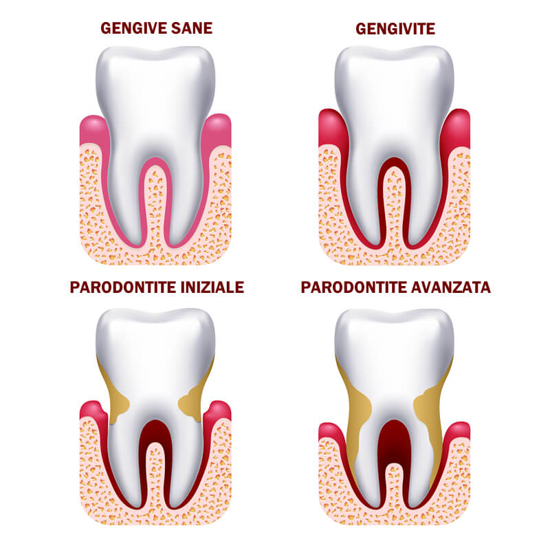 Studio Dentistico Oriolo | Ostia Lido | Parodontite 