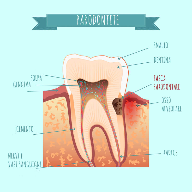 Studio Dentistico Oriolo | Ostia Lido | Parodontite 
