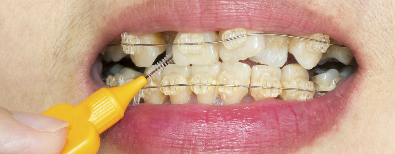 Studio Dentistico Oriolo | Ostia Lido | Tartaro e Placca Nemici Dei Denti | Ortodonzia e Tartaro