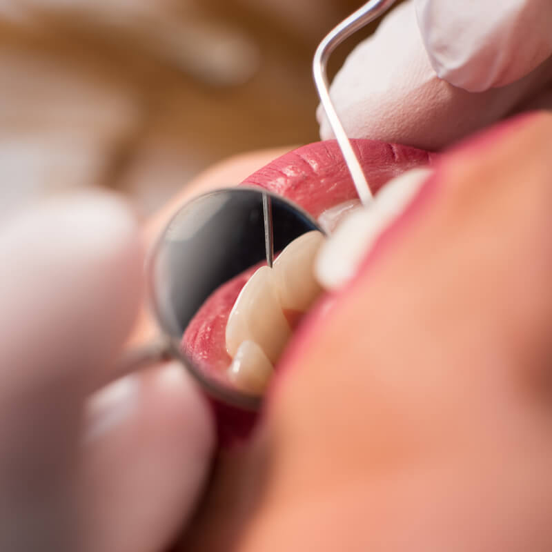 Studio Dentistico Oriolo | Ostia Lido | Tartaro e Placca Nemici Dei Denti | Visita Dentistica
