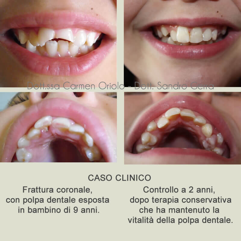 Studio Dentistico Oriolo | Ostia Lido | Infortuni Dentali | Caso Clinico
