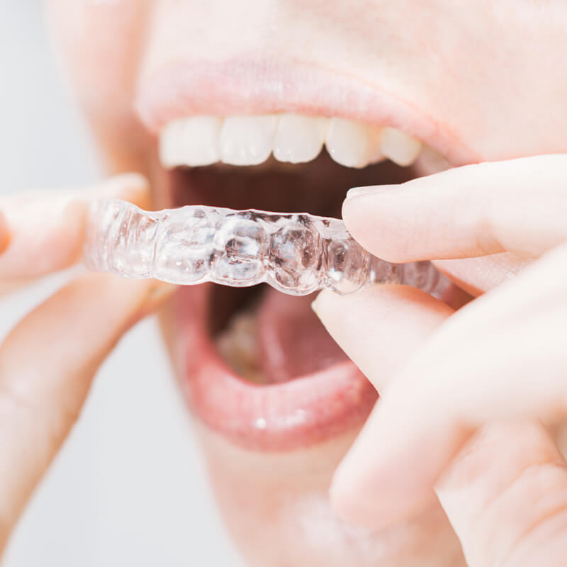 Studio Dentistico Oriolo | Ostia Lido | Ortodonzia Invisibile Invisalign | Adulti