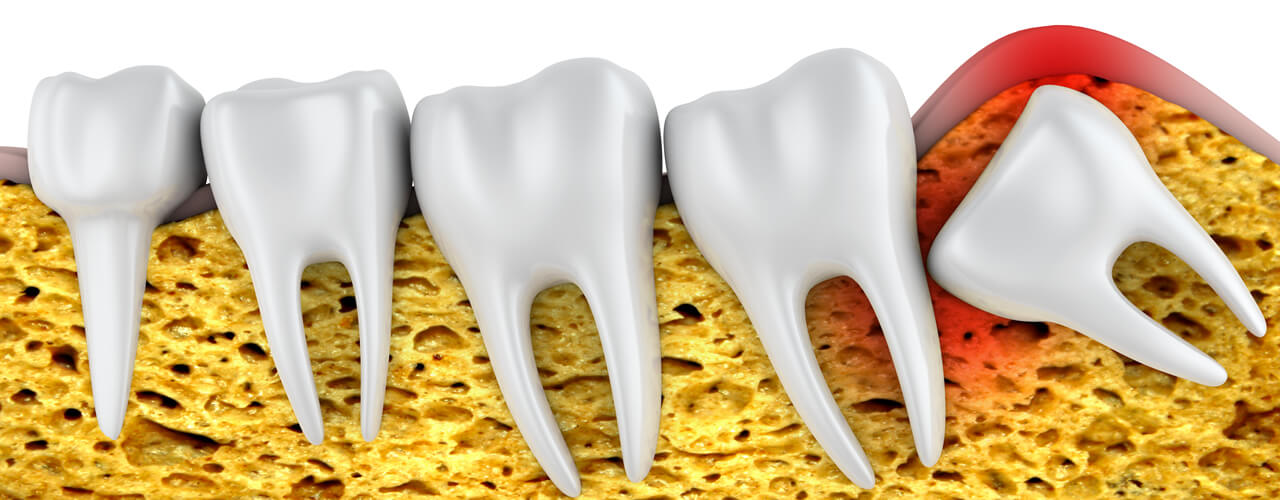 Studio Dentistico Oriolo | Ostia Lido | Denti Del Giudizio | Disodontiasi