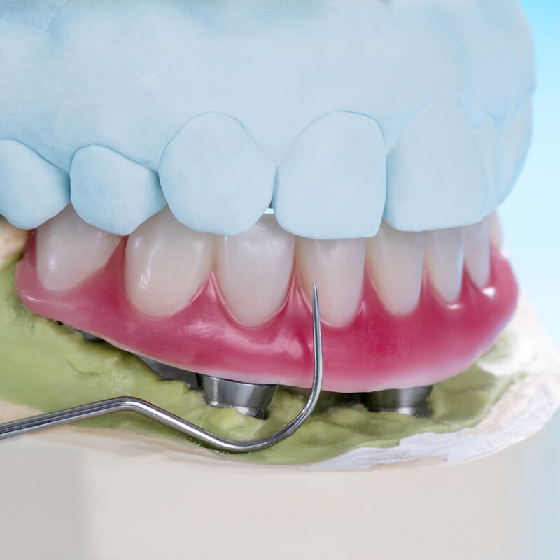 Studio Dentistico Oriolo | Parziale Superiore Ostia Lido | Protesi Mobile | Totale Su Impianti