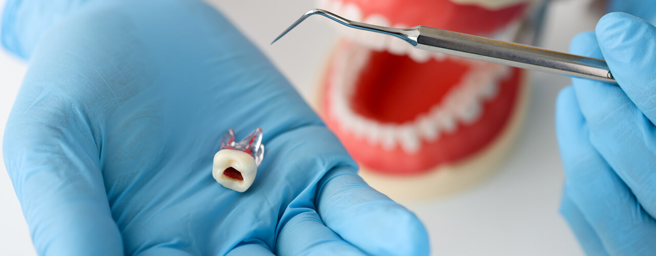 Studio Dentistico Oriolo | Parziale Superiore Ostia Lido | Ascesso Dentale | Dente Cariato