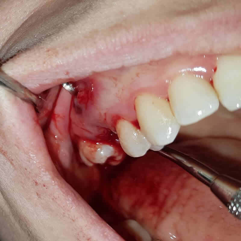 Studio Dentistico Oriolo | Parziale Superiore Ostia Lido | Ascesso Dentale | Fistola Gengivale