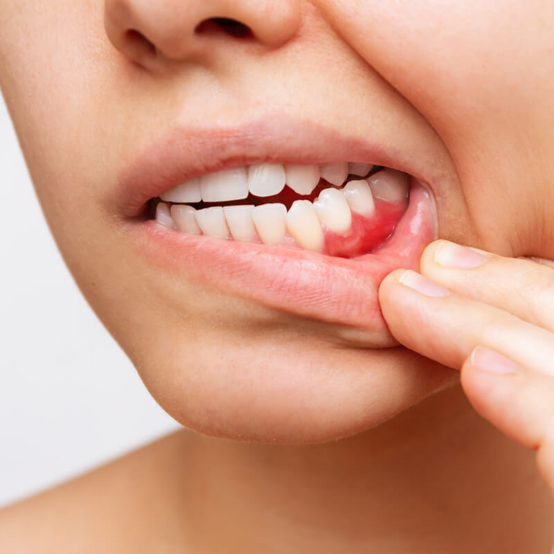 Studio Dentistico Oriolo | Parziale Superiore Ostia Lido | Ascesso Dentale | Gengive Infiammate