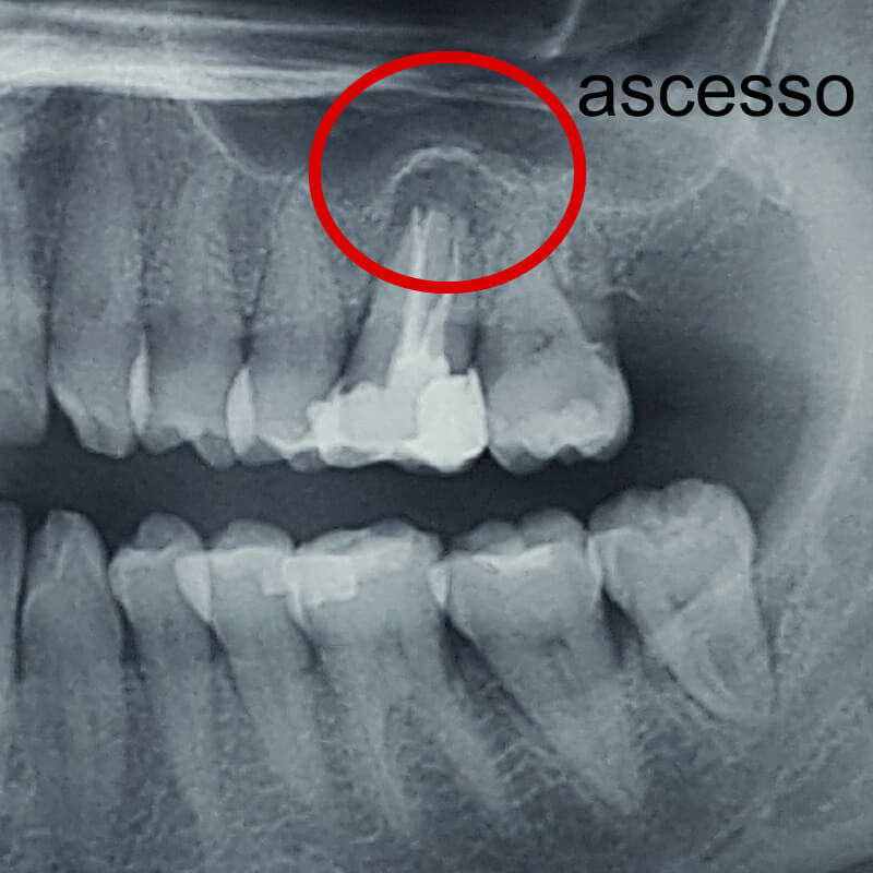 Studio Dentistico Oriolo | Parziale Superiore Ostia Lido | Ascesso Dentale | Radiografia Denti