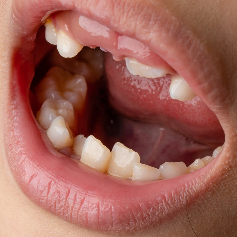 Studio Dentistico Oriolo | Parziale Superiore Ostia Lido | Dentizione Nel Bambino | Anomalie