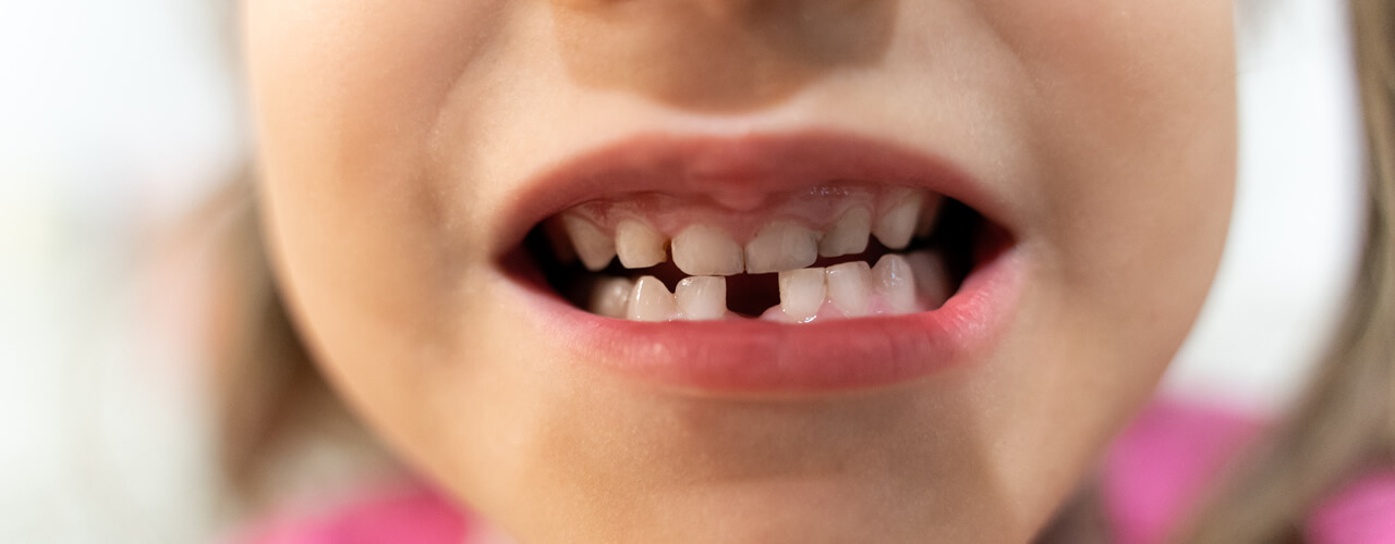 Studio Dentistico Oriolo | Parziale Superiore Ostia Lido | Dentizione Nel Bambino | Dente Caduto