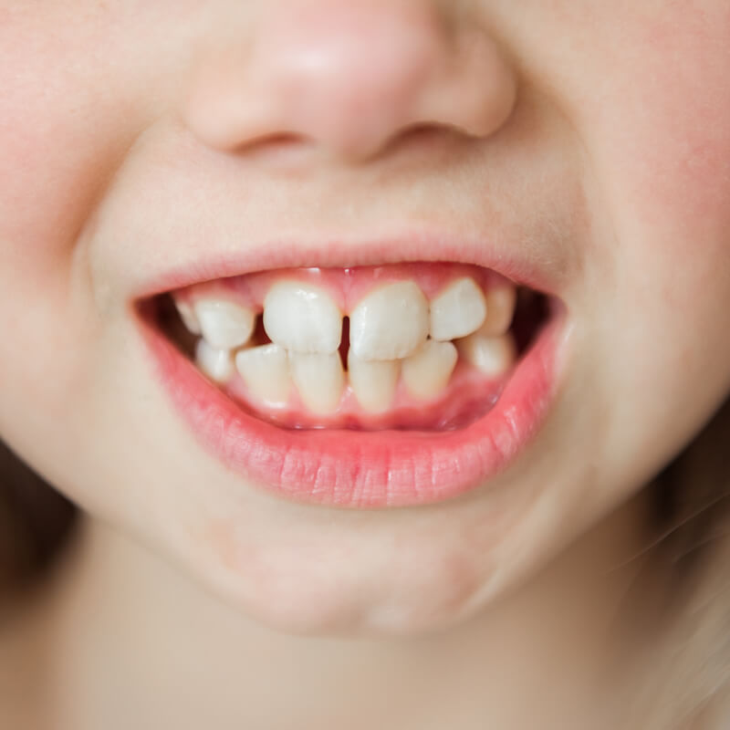 Studio Dentistico Oriolo | Parziale Superiore Ostia Lido | Dentizione Nel Bambino | Mista