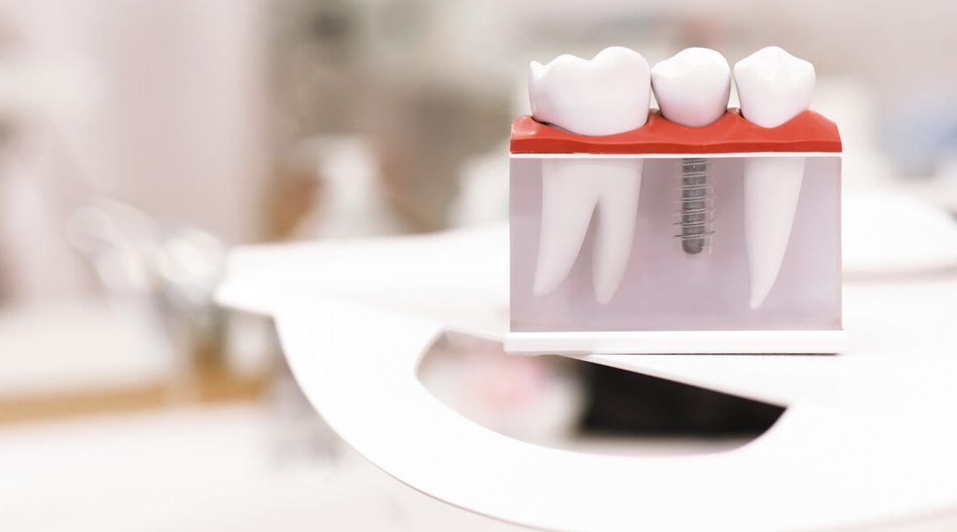 L’Implantologia dentale quando manca l’osso: GBR e Rialzo del Seno Mascellare