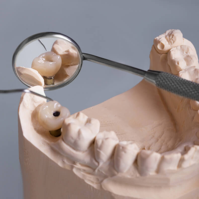 Studio Dentistico Oriolo | Ostia Lido | Implantologia Quando Manca Osso GBR Rialzo Seno Mascellare | Impianto Dentale