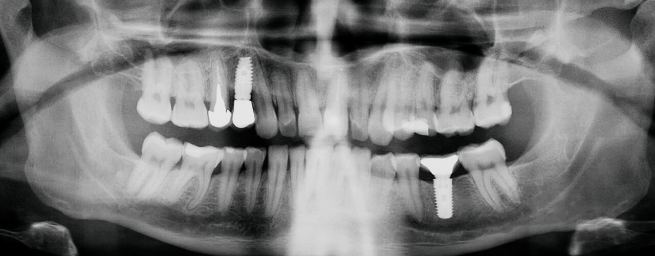 Studio Dentistico Oriolo | Ostia Lido | Implantologia Quando Manca Osso GBR Rialzo Seno Mascellare | Ortopanoramica