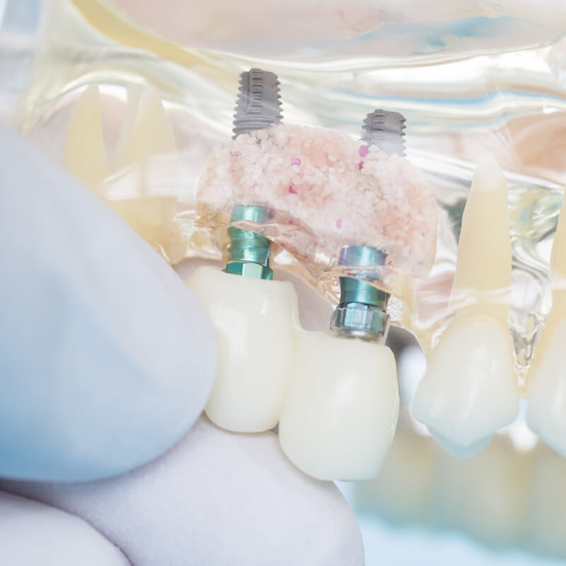 Studio Dentistico Oriolo | Ostia Lido | Implantologia Quando Manca Osso GBR Rialzo Seno Mascellare | Rigenerazione Ossea