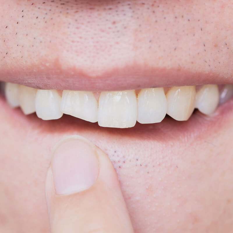 Studio Dentistico Oriolo | Ostia Lido | Visita Dentistica Dopo Le Vacanze | Trauma Dentale