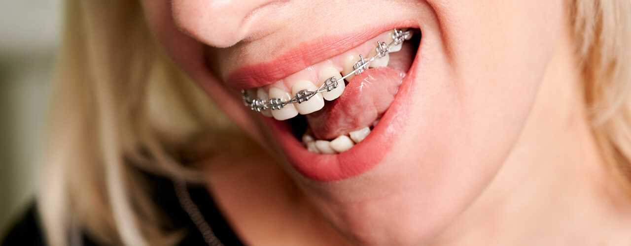 Studio Dentistico Oriolo | Ostia Lido | Ortodonzia Fissa Problemi e Consigli Durante la Terapia | Brackets
