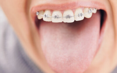Ortodonzia fissa: problemi e consigli durante la terapia