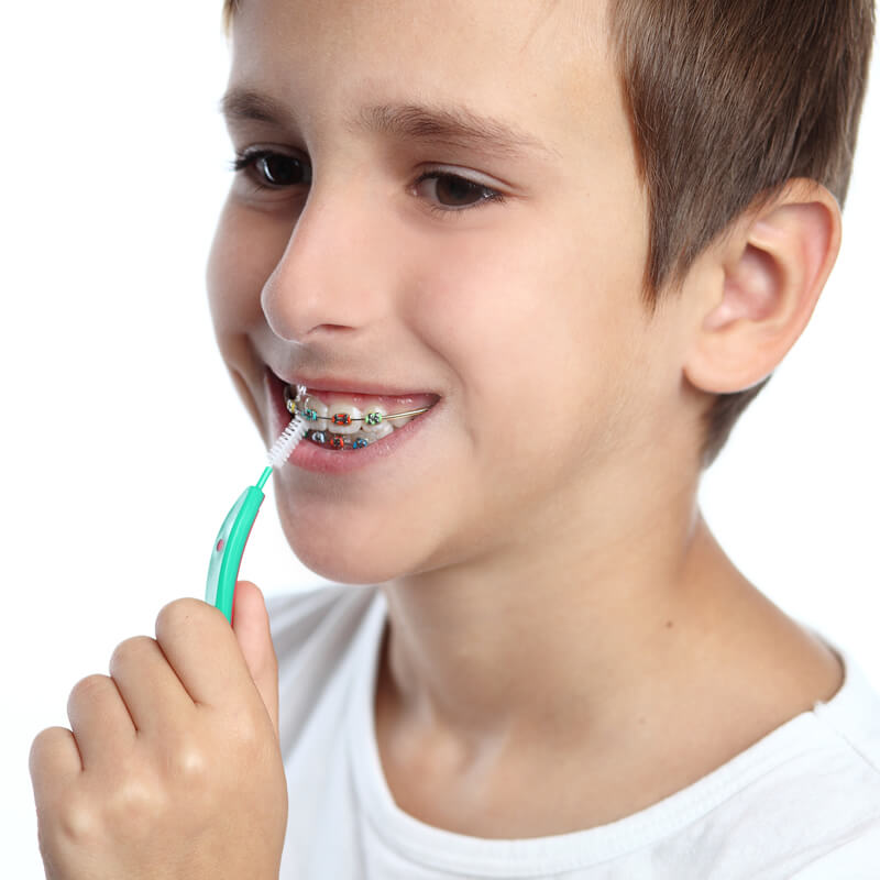Studio Dentistico Oriolo | Ostia Lido | Ortodonzia Fissa Problemi e Consigli Durante la Terapia | Igiene Orale
