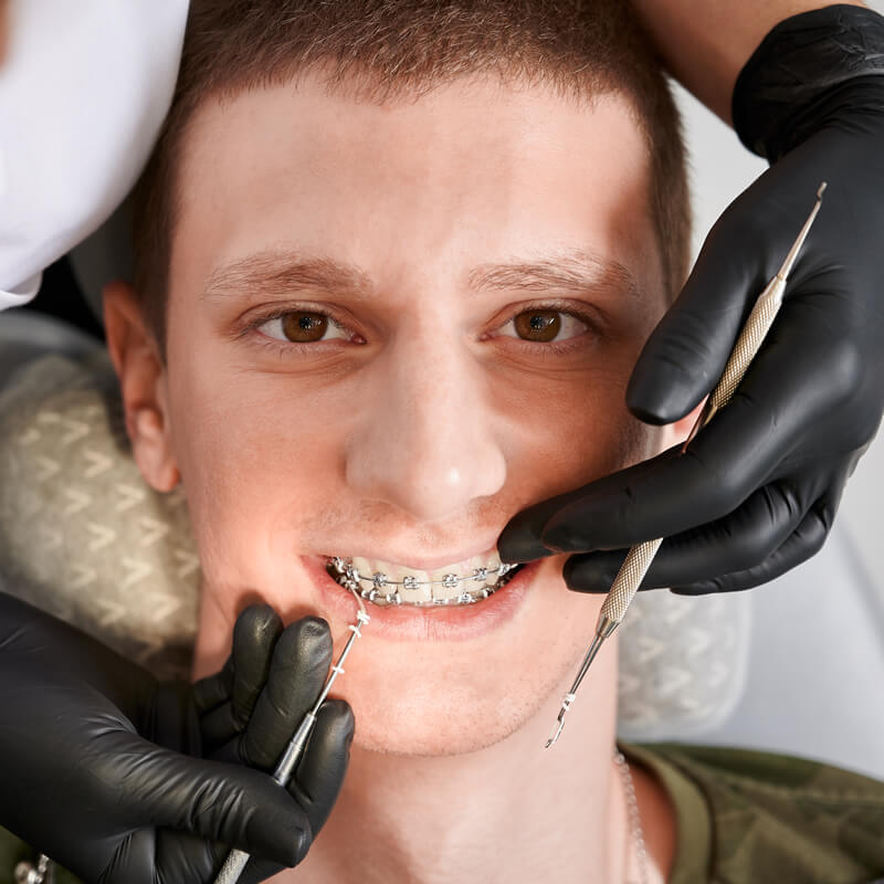 Studio Dentistico Oriolo | Ostia Lido | Ortodonzia Fissa Problemi e Consigli Durante la Terapia | Ortodontista