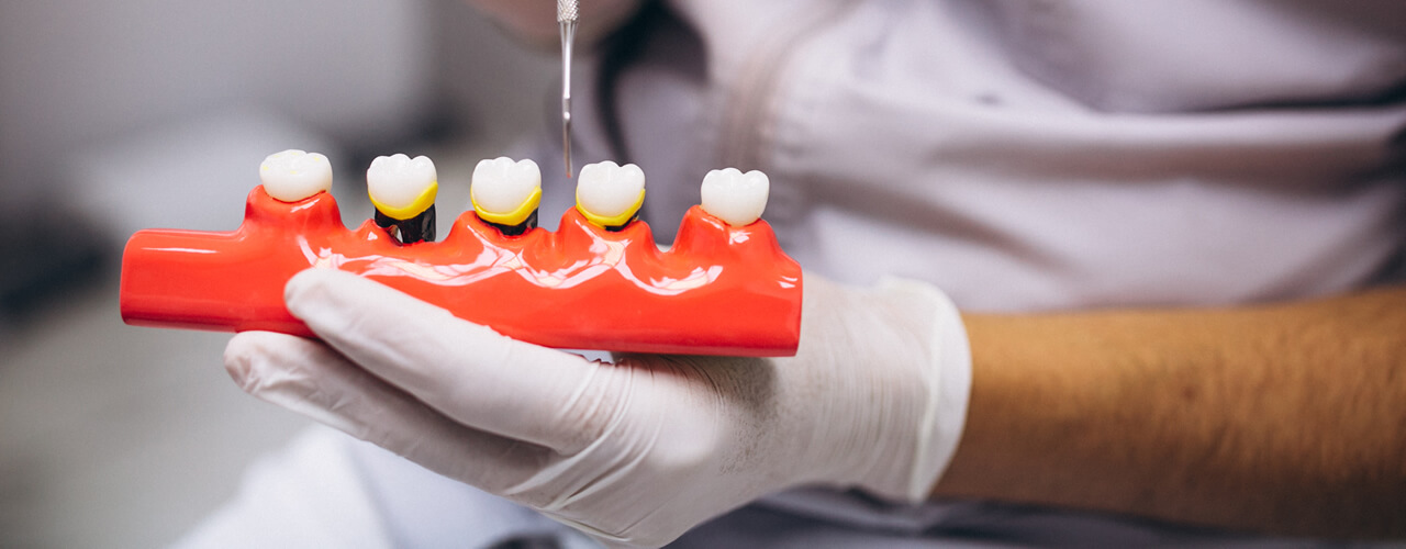 Studio Dentistico Oriolo | Lido di Ostia | Diabete e Parodontite un Legame Reciproco | Parodonto