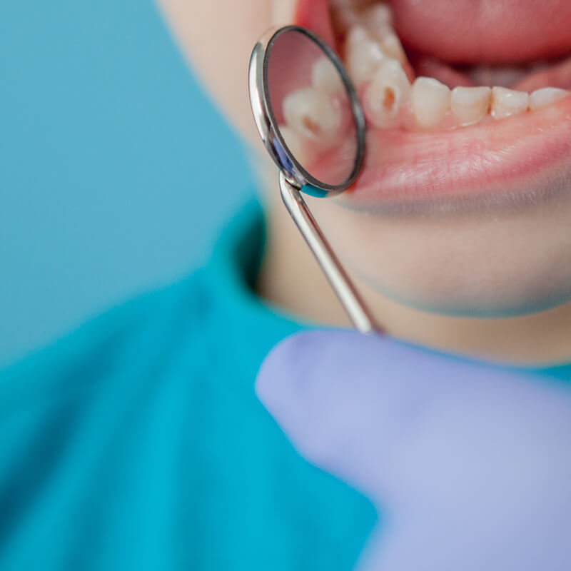 Studio Dentistico Oriolo | Lido di Ostia | Cosa Controllare Nella Bocca Del Tuo Bambino Un Guida Per Genitori | Carie