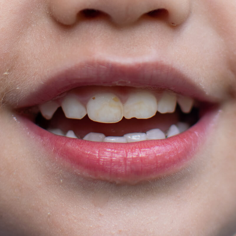 Studio Dentistico Oriolo | Lido di Ostia | Cosa Controllare Nella Bocca Del Tuo Bambino Un Guida Per Genitori | Difetti Dello Smalto