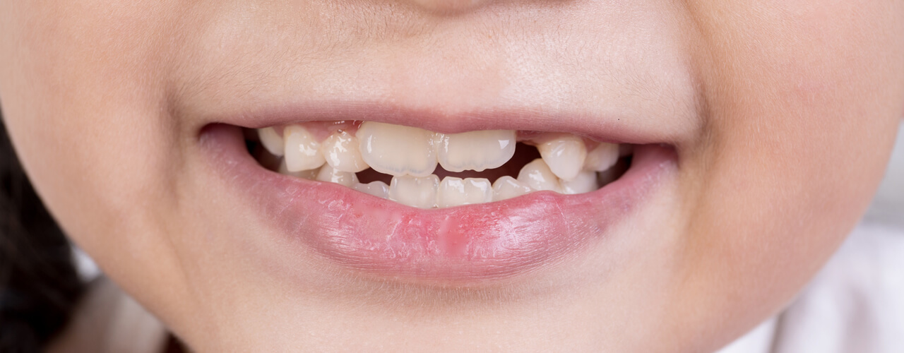 Studio Dentistico Oriolo | Lido di Ostia | Cosa Controllare Nella Bocca Del Tuo Bambino Un Guida Per Genitori | Malocclusione