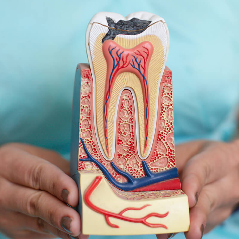 Studio Dentistico Oriolo | Lido di Ostia | Domande e Risposte sulle Otturazioni Dentali | Dente Cariato
