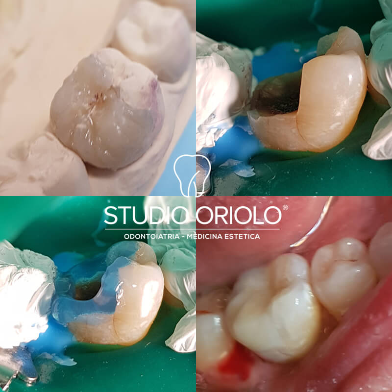 Studio Dentistico Oriolo | Lido di Ostia | Domande e Risposte sulle Otturazioni Dentali | Intarsio