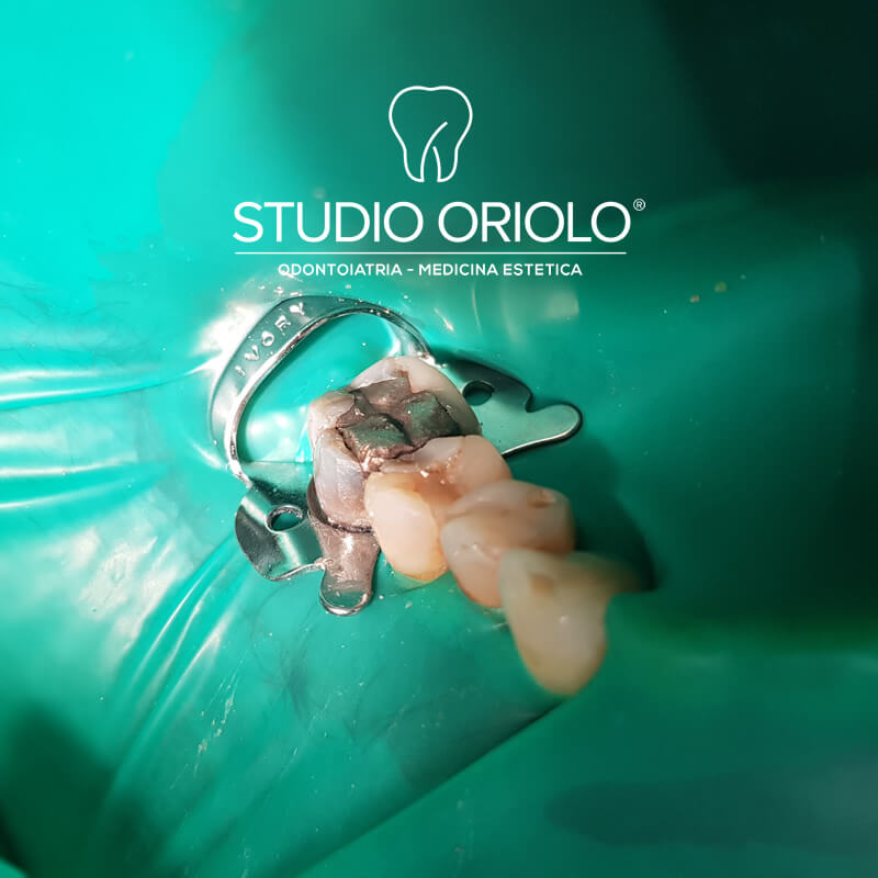 Studio Dentistico Oriolo | Lido di Ostia | Domande e Risposte sulle Otturazioni Dentali | Otturazione in Amalgama